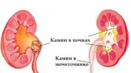 Патологическая анатомия камнеобразования