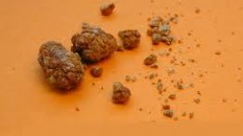 Дифференциальный диагноз почечнокаменной болезни